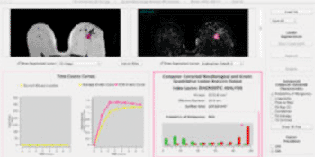 Imagen: La estación de trabajo de análisis de imagen cuantitativo en el laboratorio Giger para evaluar las lesiones de mama observadas en las RMs, mostrando la segmentación automatizada de la lesión, extracción de la característica (volumétrica, morfología, textura, cinética), y cálculo de la probabilidad de malignidad(Fotografía cortesía de SPIE).